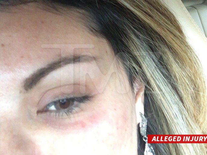 Imagem do olho de Liziane, após suposta agressão (TMZ/Reprodução)