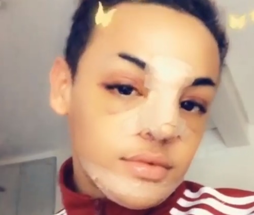 Pabllo passou por cirurgia no nariz (Reprodução/Instagram)