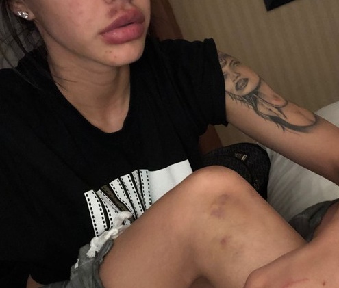 Duda Castro mostrou foto de agressão; Biel também a acusa de agredi-lo (Reprod.)