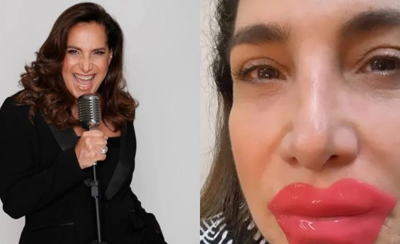 Totia Meirelles - harmonização facial